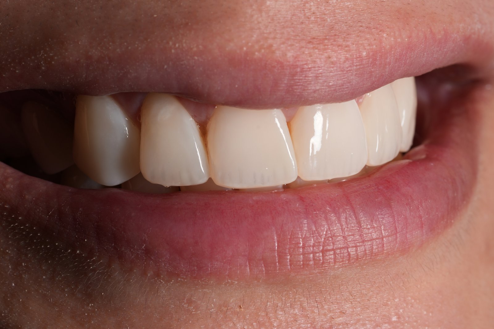 Sorriso natural após facetas feitas pelo Dr. Mateus Francês